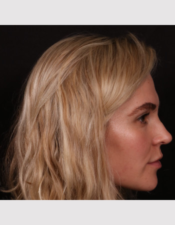After Image: Rhinoplasty - right-side