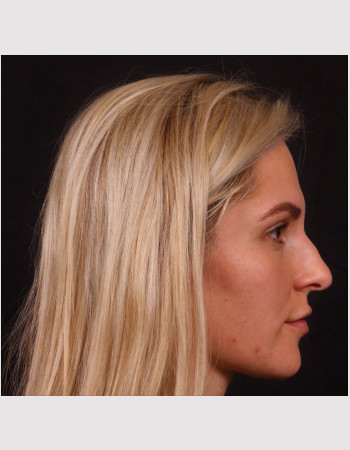 Before Image: Rhinoplasty - right-side