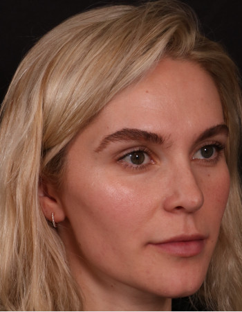 After Image: Rhinoplasty - right-front-oblique