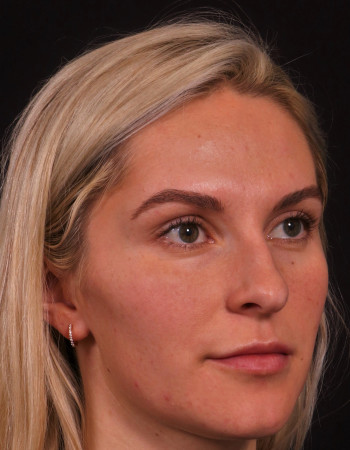 Before Image: Rhinoplasty - right-front-oblique