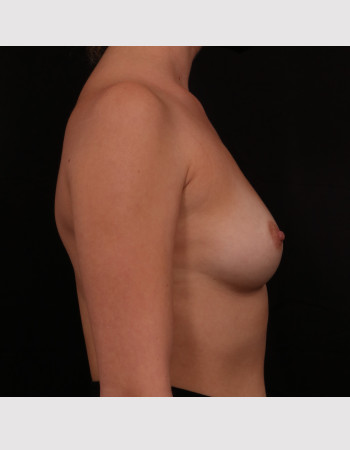 Before Image: Breast Augmentation - right-side
