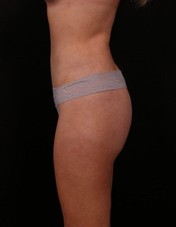 After Image: Tummy Tuck (Abdominoplasty) - left-side