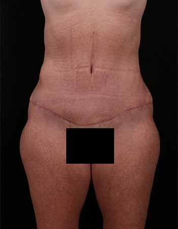 After Image: Tummy Tuck (Abdominoplasty) - front