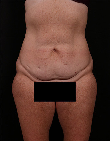 Before Image: Tummy Tuck (Abdominoplasty) - front