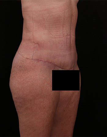 After Image: Tummy Tuck (Abdominoplasty) - right-front-oblique