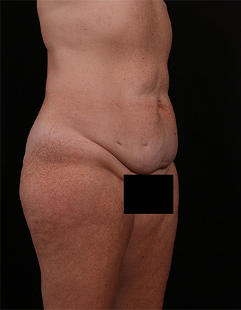 Before Image: Tummy Tuck (Abdominoplasty) - right-front-oblique