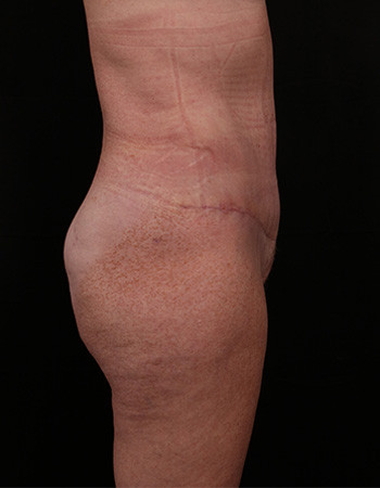 After Image: Tummy Tuck (Abdominoplasty) - right-side