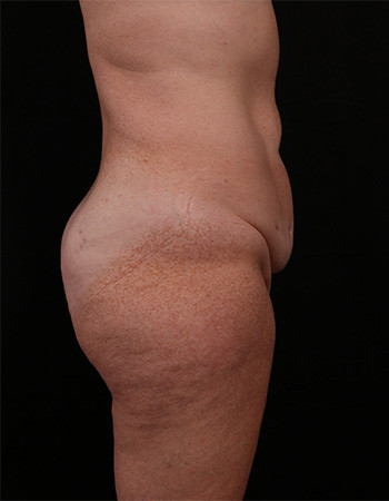 Before Image: Tummy Tuck (Abdominoplasty) - right-side
