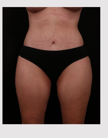 Before and 6 months after tummy tuck (abdominoplasty)