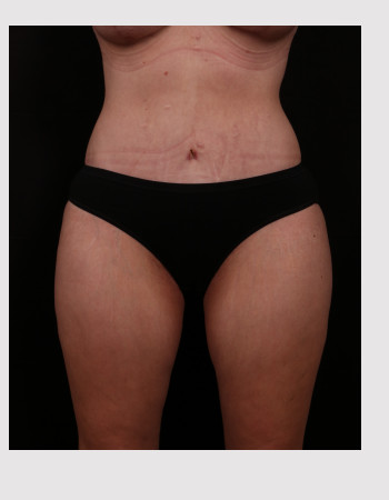 After Image: Tummy Tuck (Abdominoplasty) - front