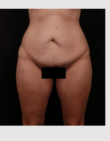 Before and 6 months after tummy tuck (abdominoplasty)