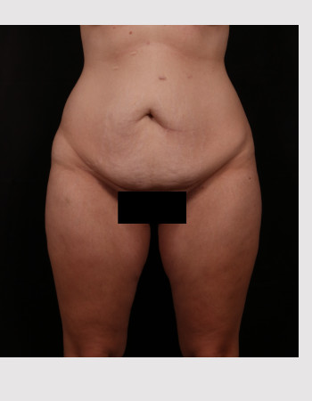 Before Image: Tummy Tuck (Abdominoplasty) - front