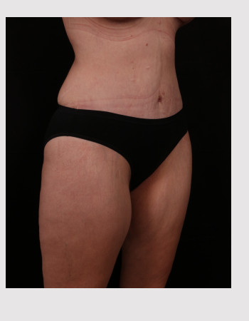 After Image: Tummy Tuck (Abdominoplasty) - right-front-oblique