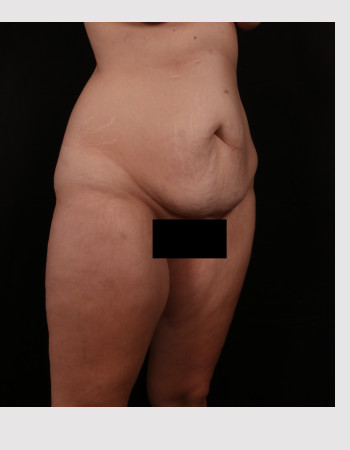 Before Image: Tummy Tuck (Abdominoplasty) - right-front-oblique