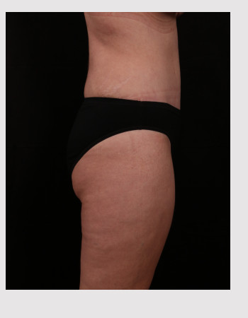 After Image: Tummy Tuck (Abdominoplasty) - right-side