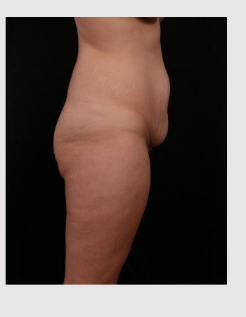 Before Image: Tummy Tuck (Abdominoplasty) - right-side
