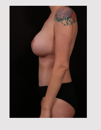 After Image: Mommy Makeover - left-side