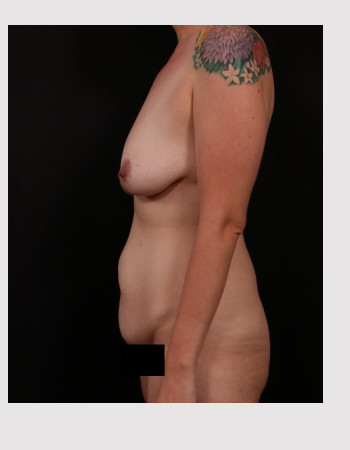 Before Image: Mommy Makeover - left-side