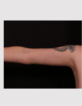 After Image: Brachioplasty - front