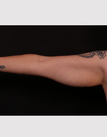 Before Image: Brachioplasty - front