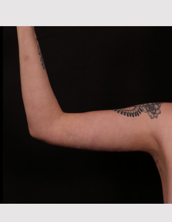 After Image: Brachioplasty - front