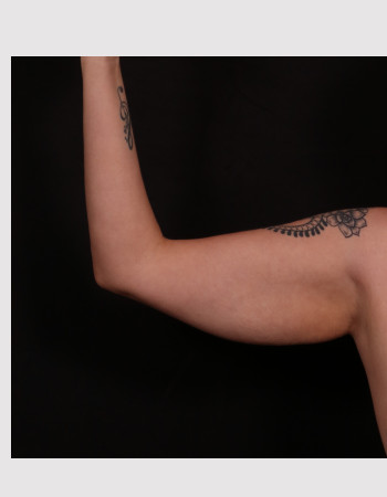 Before Image: Brachioplasty - front