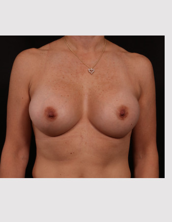 After Image: Breast Augmentation - front