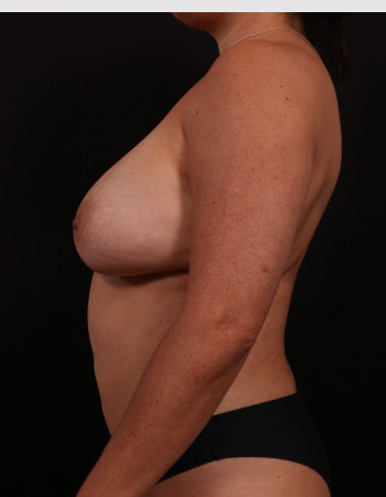 Before Image: Mommy makeover - other