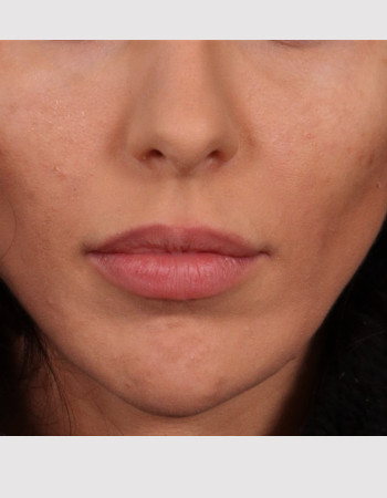 After Image: Buccal Fat Removal - front