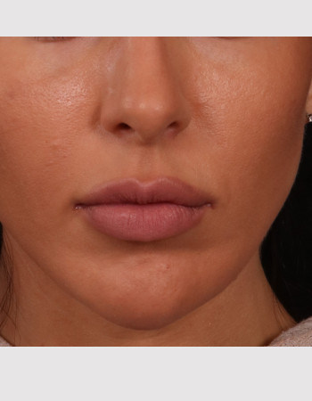 Before Image: Buccal Fat Removal - front