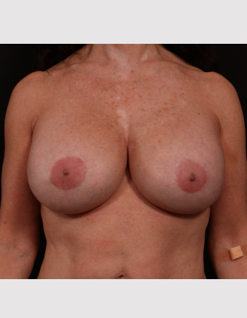 After Image: Secondary Breast Enhancement - front