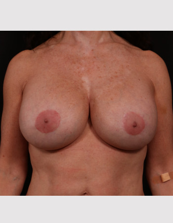 Secondary Breast Enhancement