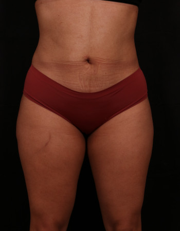 After Image: Liposuction - front