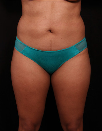 Before Image: Liposuction - front