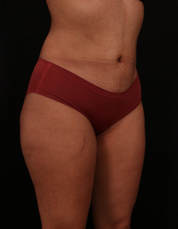 After Image: Liposuction - right-front-oblique