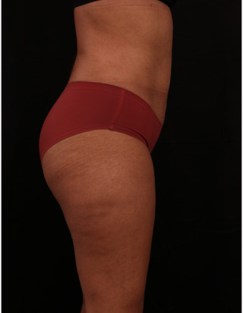 After Image: Liposuction - other