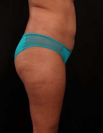Before Image: Liposuction - other
