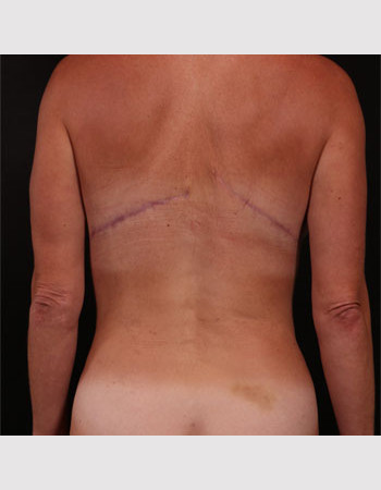 After Image: Bra Strap Excision - back