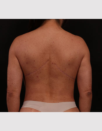 After Image: Bra Strap Excision - back