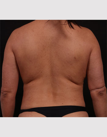 Before Image: Bra Strap Excision - back