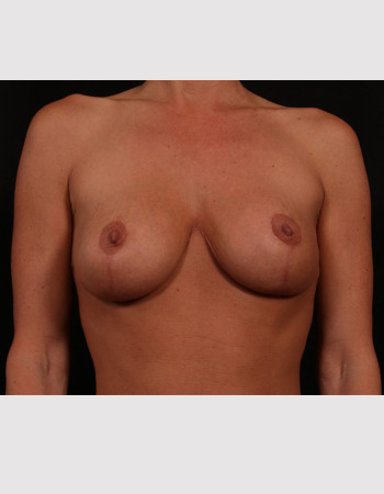 After Image: Mastopexy (Breast Lift) - front
