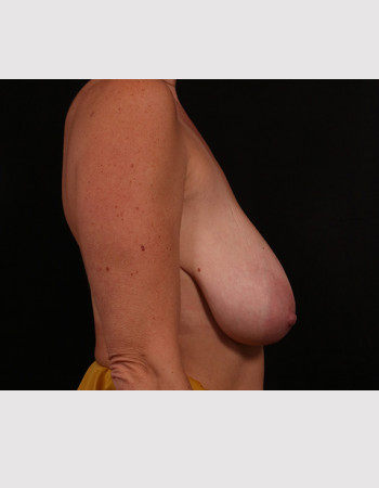 Before Image: Mastopexy (Breast Lift) - right-side