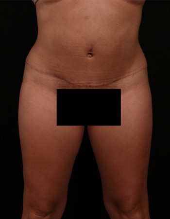 After Image: Tummy Tuck (Abdominoplasty) - front