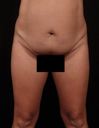 Before Image: Tummy Tuck (Abdominoplasty) - front