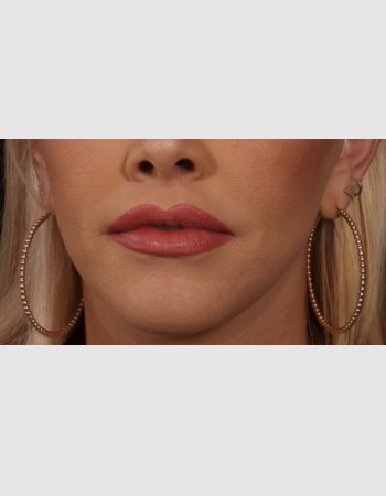 After Image: Lip Lift - front