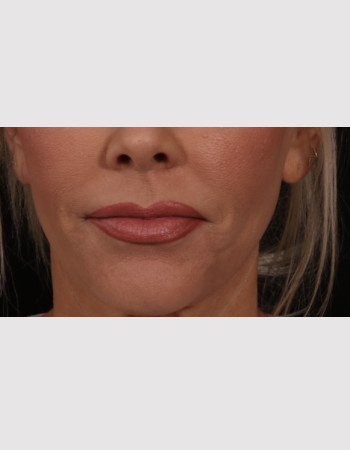 Before Image: Lip Lift - front