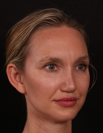 After Image: Rhinoplasty - right-front-oblique