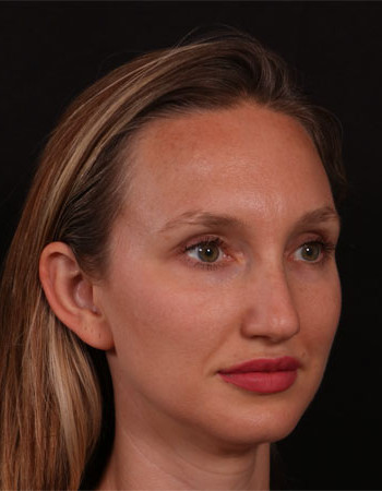Before Image: Rhinoplasty - right-front-oblique