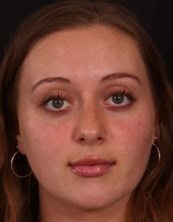 After Image: Buccal Fat Removal - front