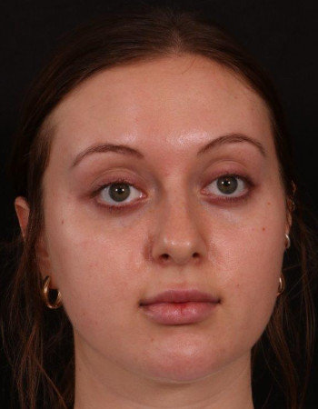 Before Image: Buccal Fat Removal - front
